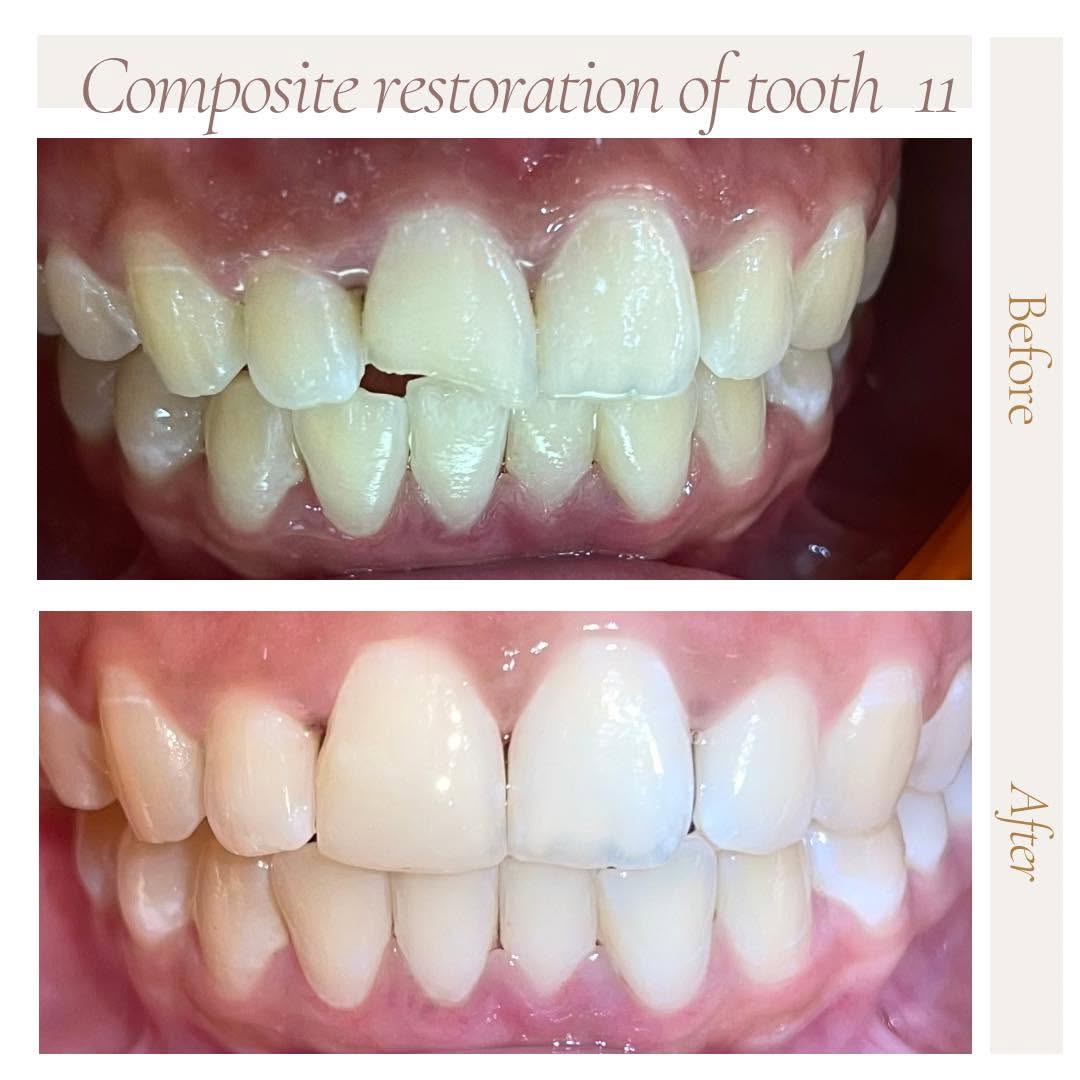 Composite Restoration — Tooth 11 Repair at Fradejas Dental Care Clinic
